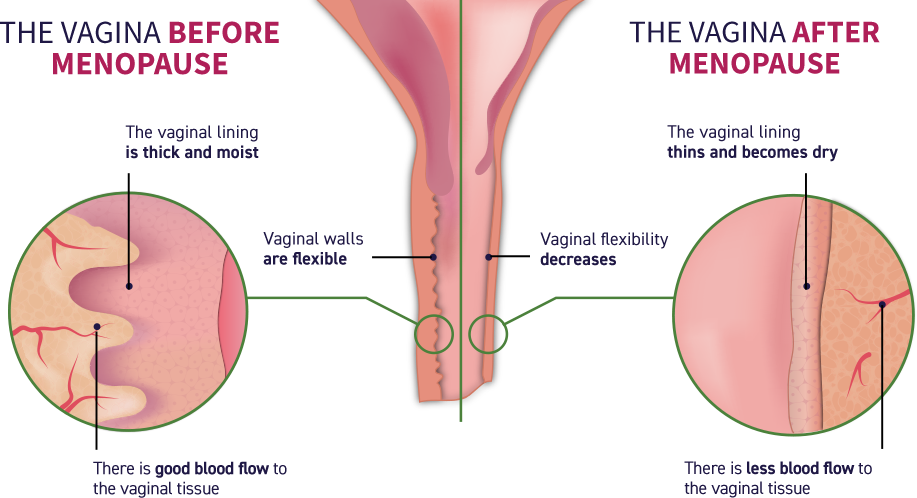 Painful Sex After Menopause: Vulvar & Vaginal Atrophy (VVA)